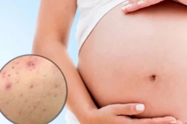 As mães grávidas têm acne nas costas: 6 causas e soluções